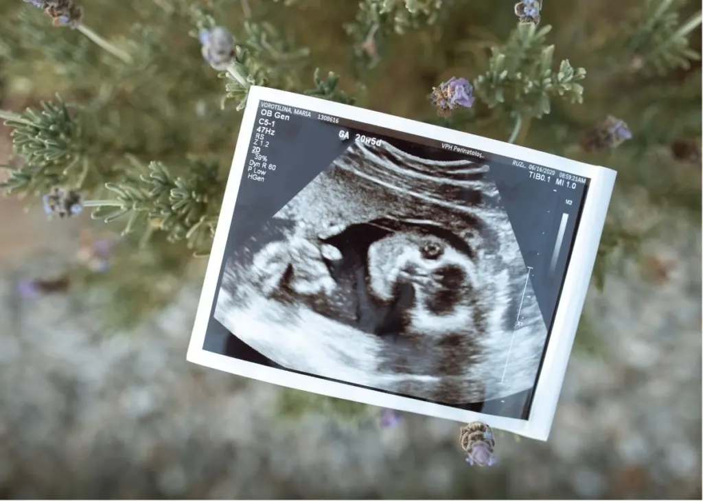 An ultrasound photo hanging from a Christmas tree.
