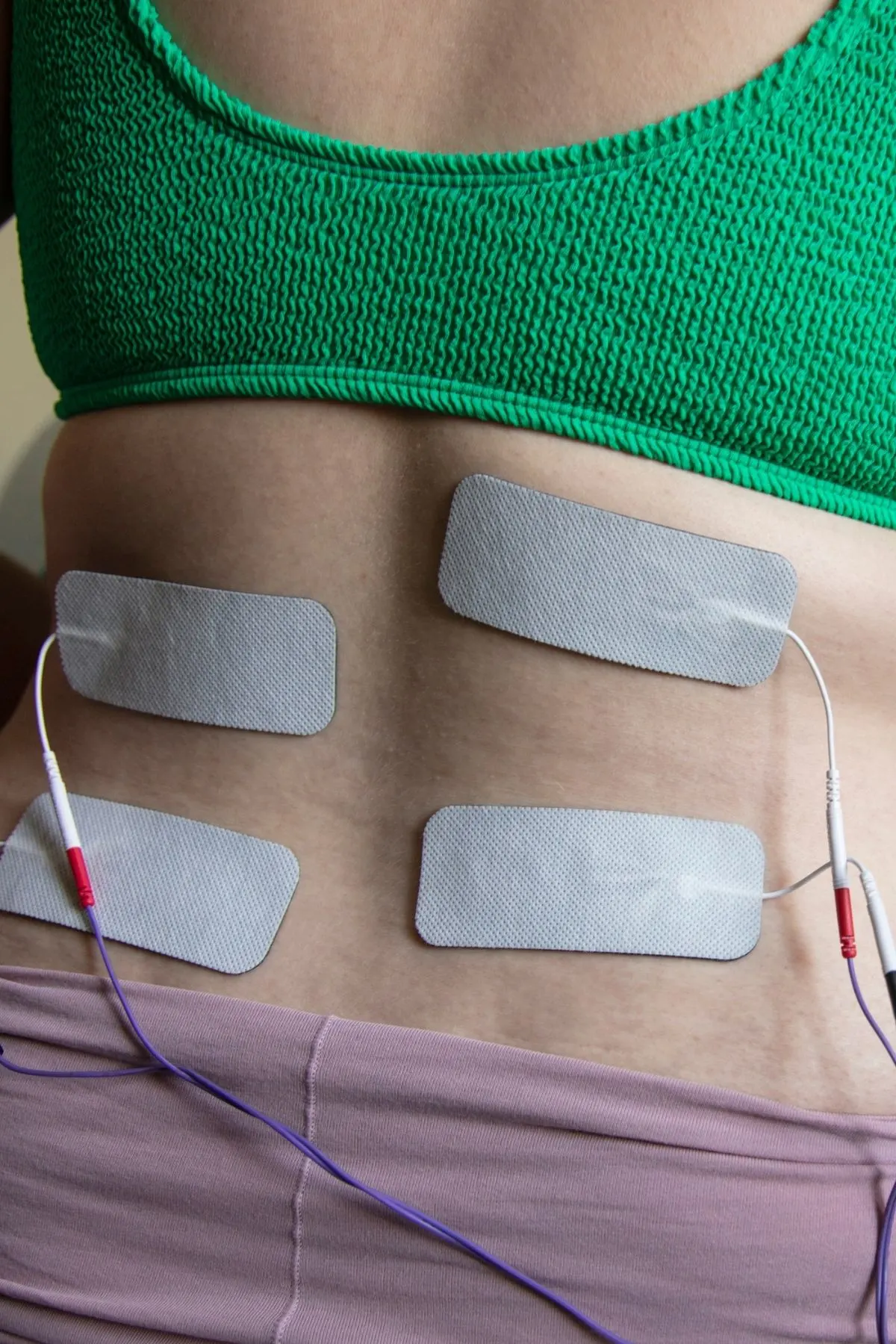 Woman shows her back patched with electrical wires from TENS machine during labor.